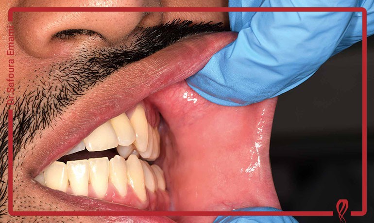 تشخیص زودهنگام شکست درمان ریشه؛ روش‌های کلینیکی و رادیوگرافی